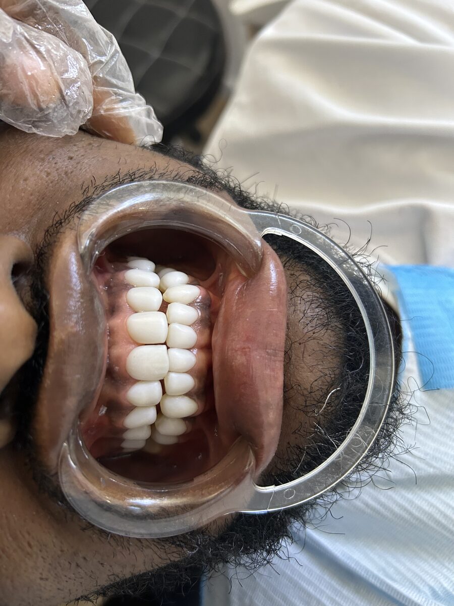 Close detail of fitted dental veneers showing tooth shape and shade
