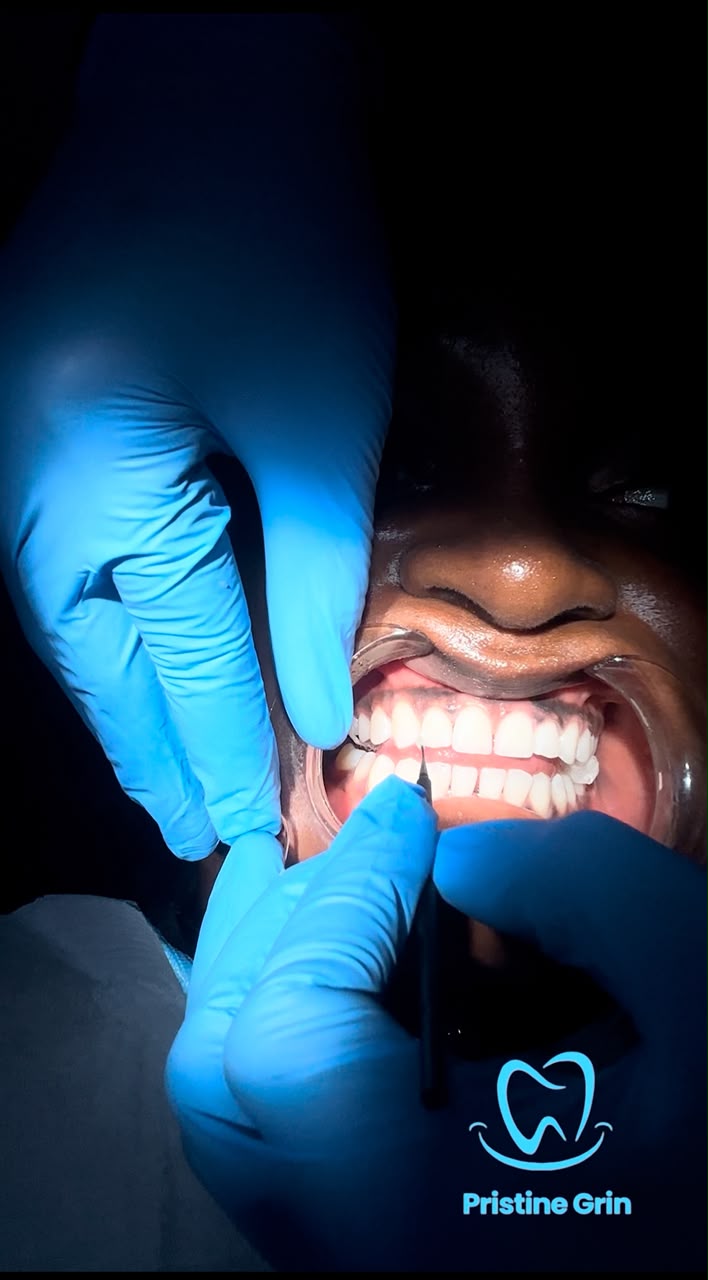 Whitening treatment being carried out with gum protection in place