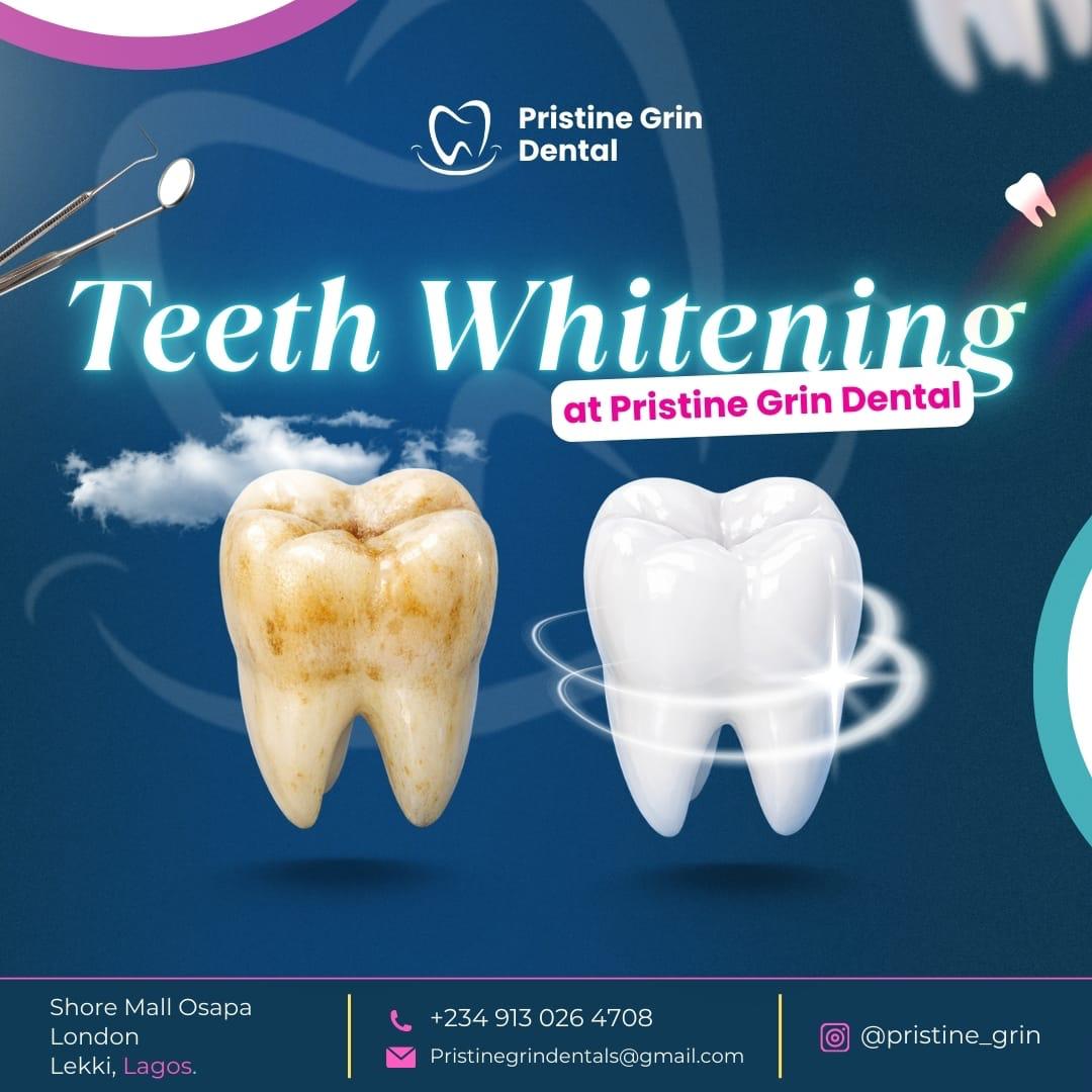 Teeth whitening results at Pristine Grin Dental