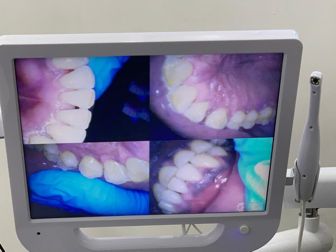 Inner-surface staining removed — after treatment