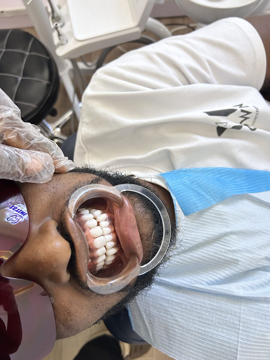 Finished porcelain veneers on the upper front teeth at Pristine Grin Dental
