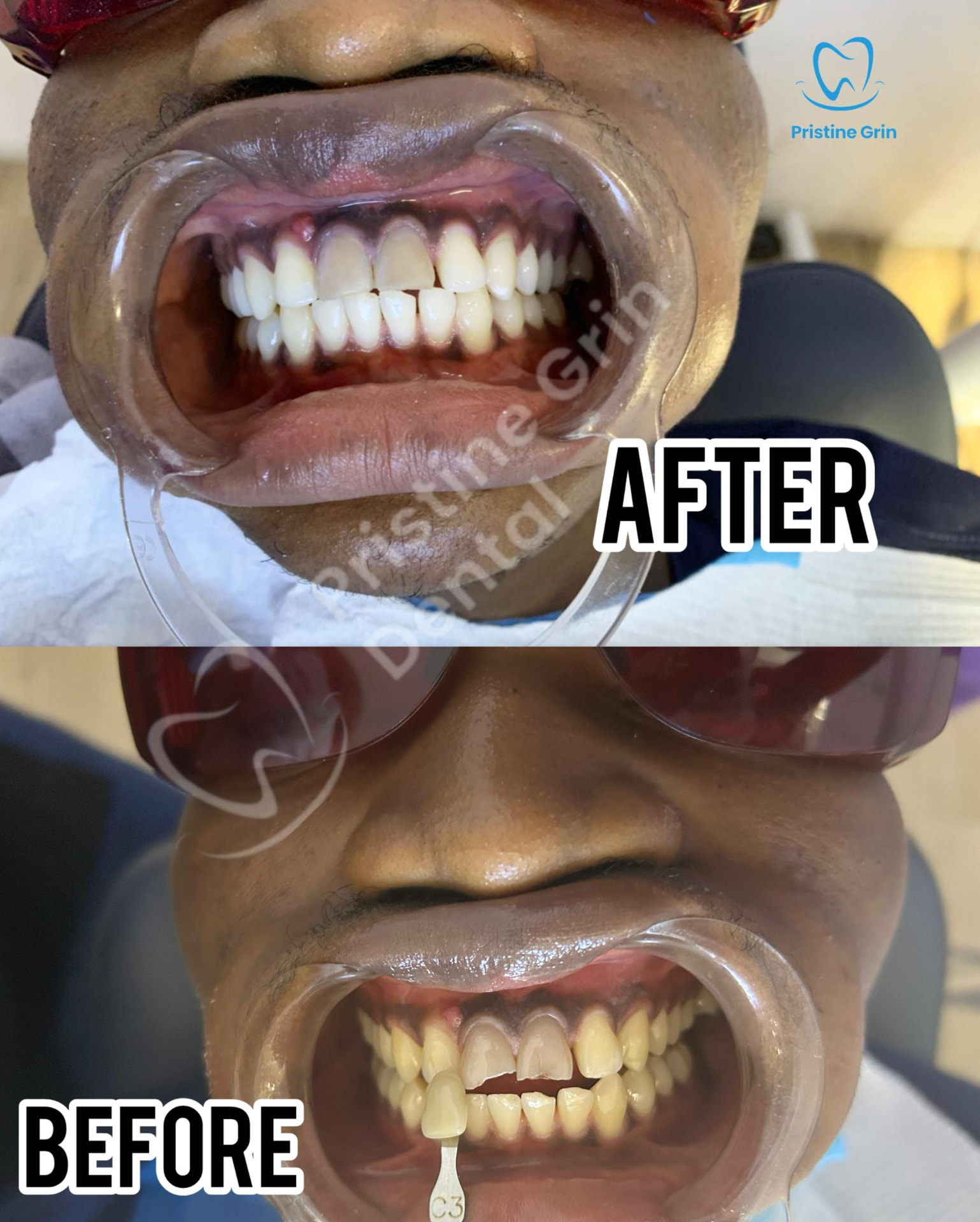 Before and after professional teeth whitening at Pristine Grin Dental