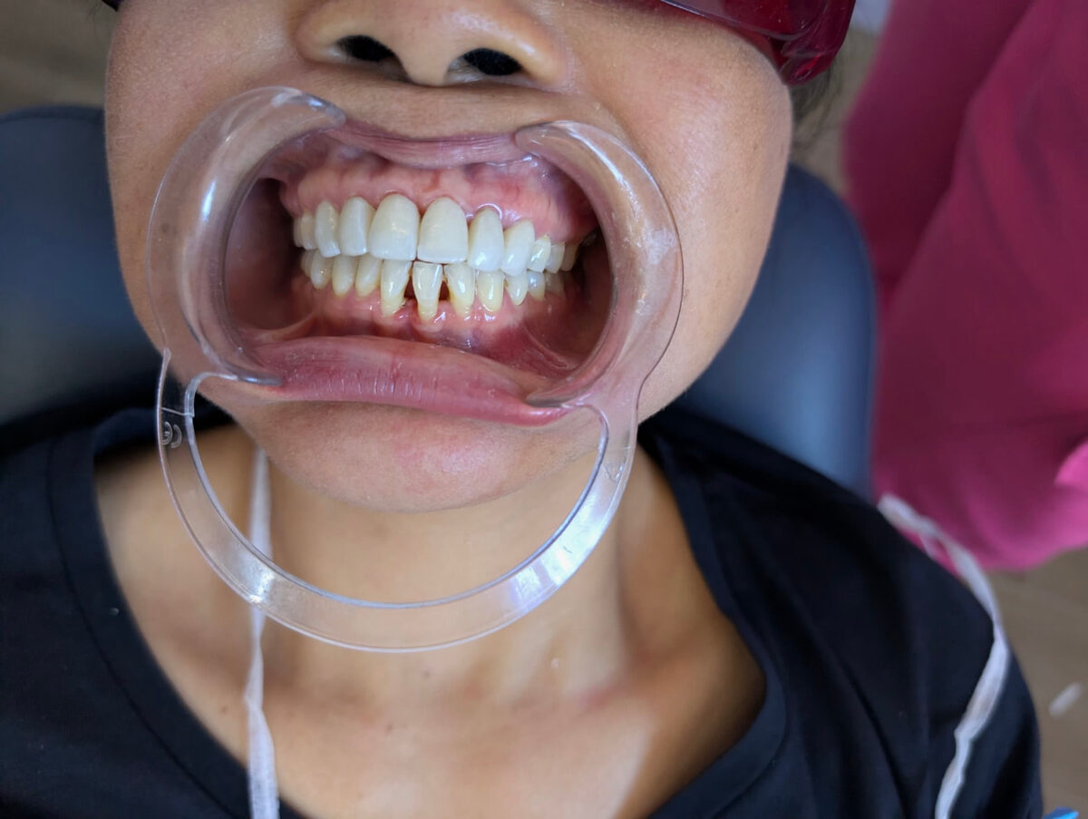 Heavy build-up cleared from the lower front teeth — after treatment