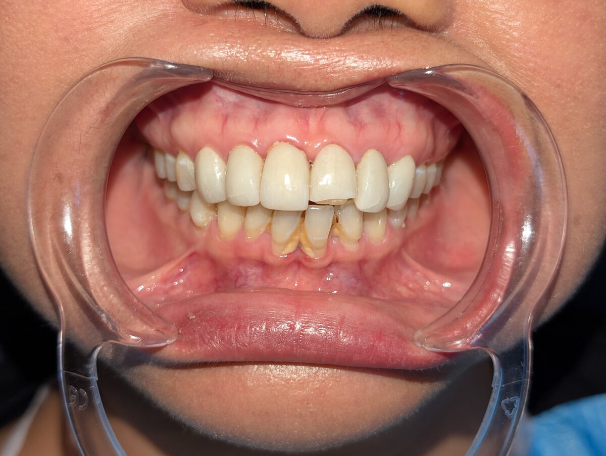 Heavy build-up cleared from the lower front teeth — before treatment