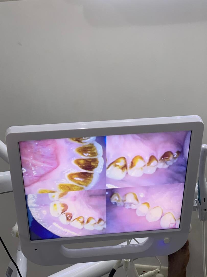 Every side of the mouth, cleaned — before treatment