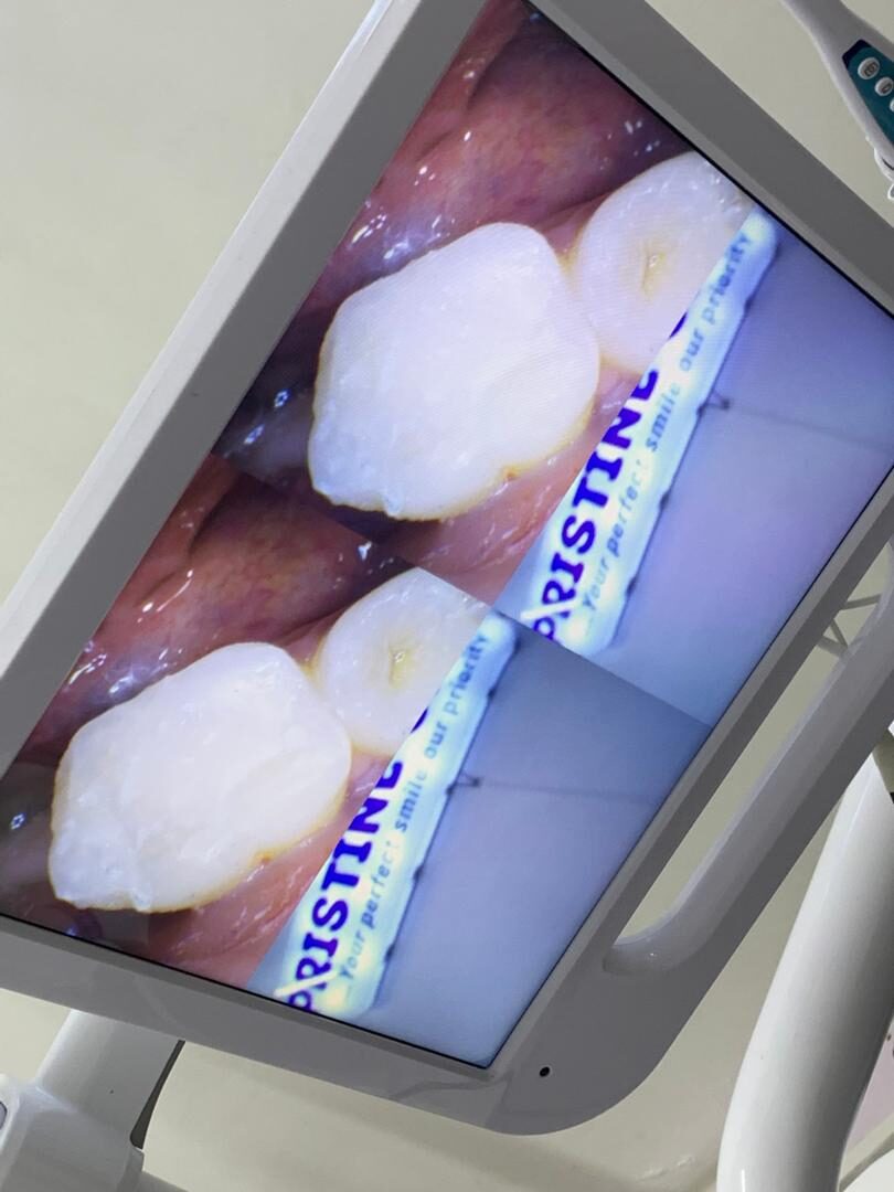 Large cavity filled in a back tooth — after treatment