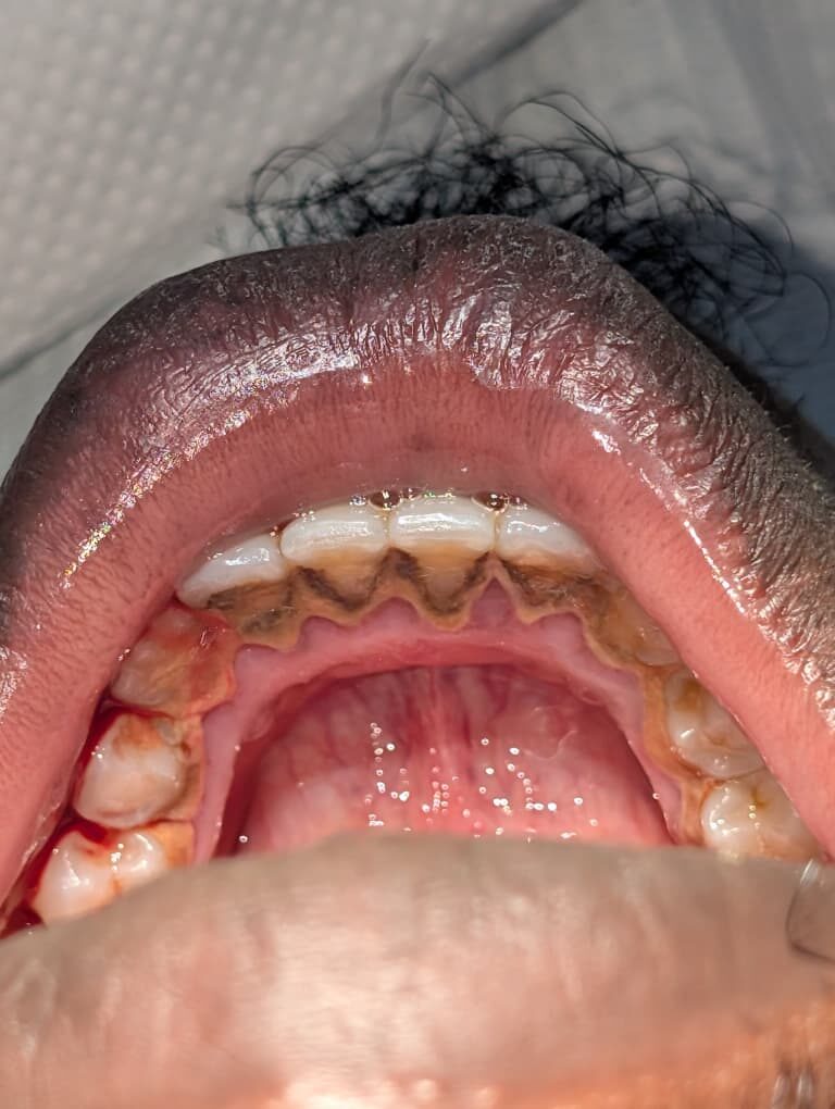 Tartar cleared from the back of the lower teeth — before treatment
