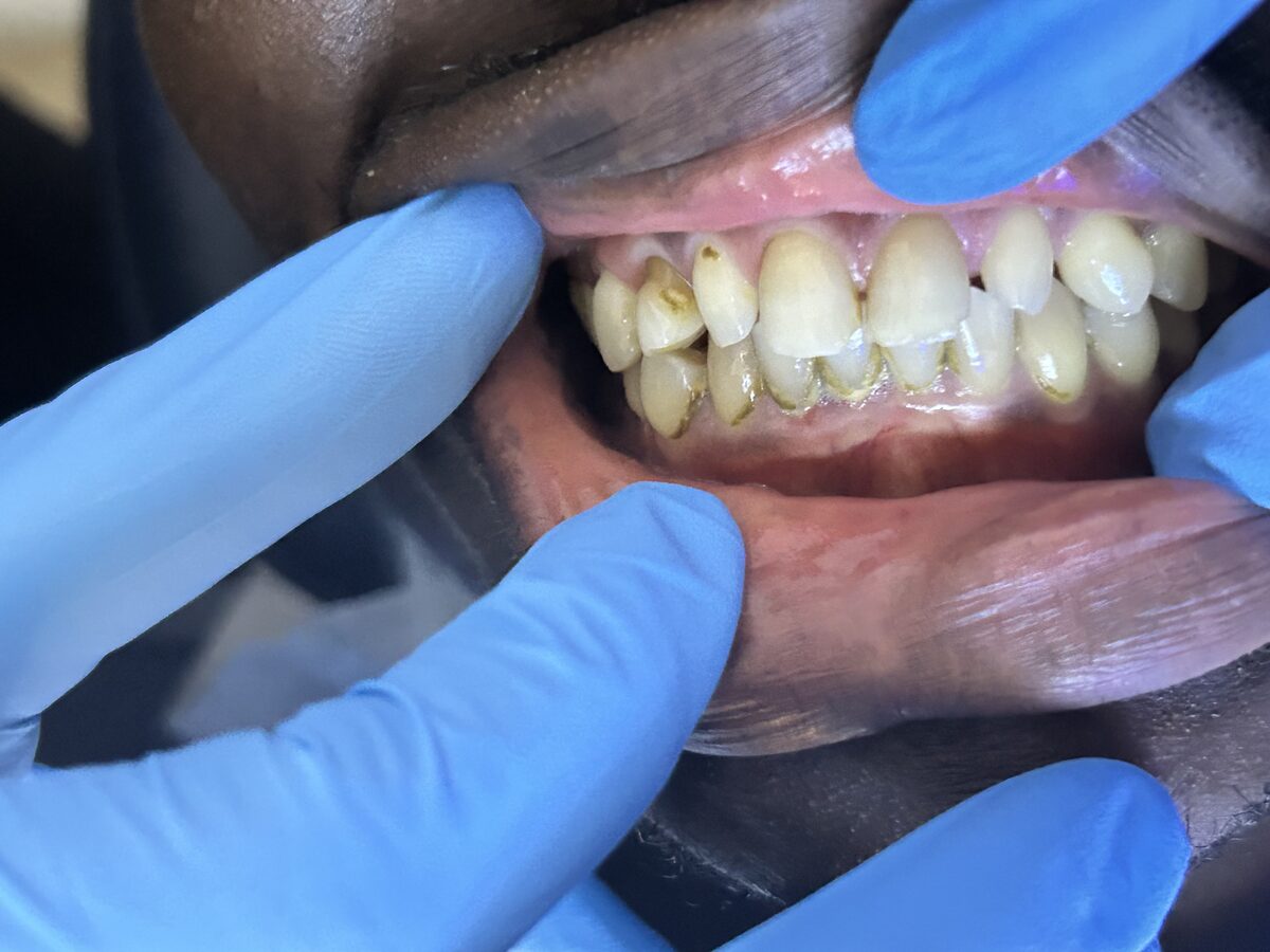 Cleaner gumline, smoother teeth — before treatment