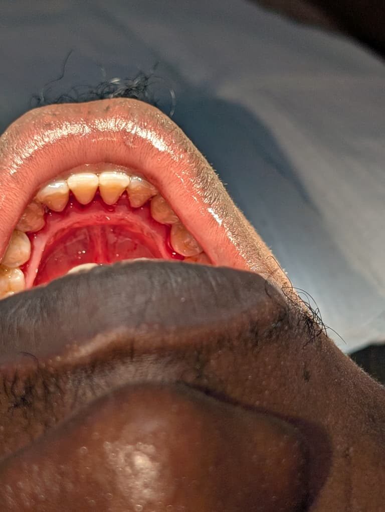 Tartar cleared from the back of the lower teeth — after treatment