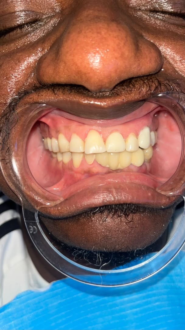 Full upper restoration — after treatment
