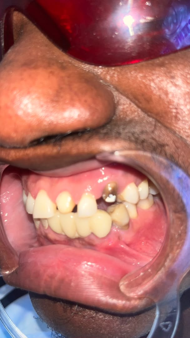 Full upper restoration — before treatment