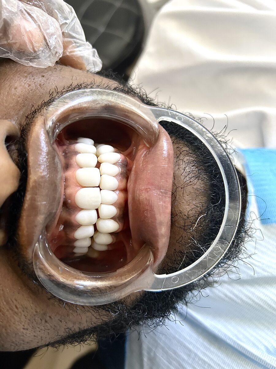 Wider view of a completed veneers result in the clinic