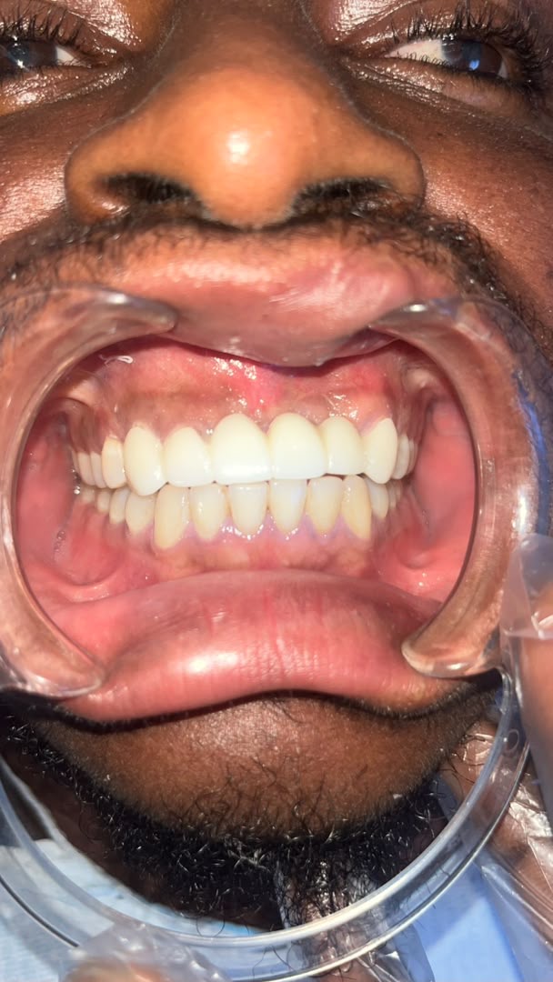 Closing gaps and rebuilding the bite — after treatment