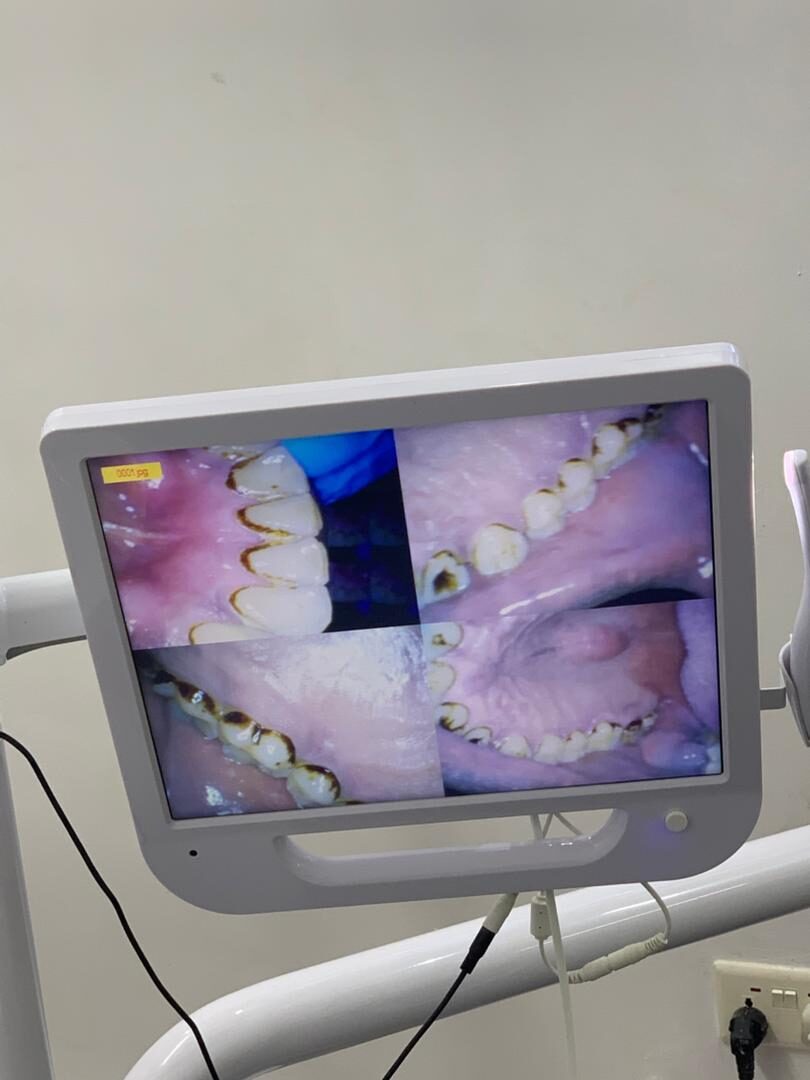 Inner-surface staining removed — before treatment