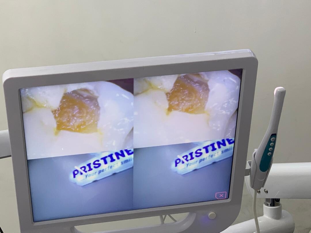 Large cavity filled in a back tooth — before treatment