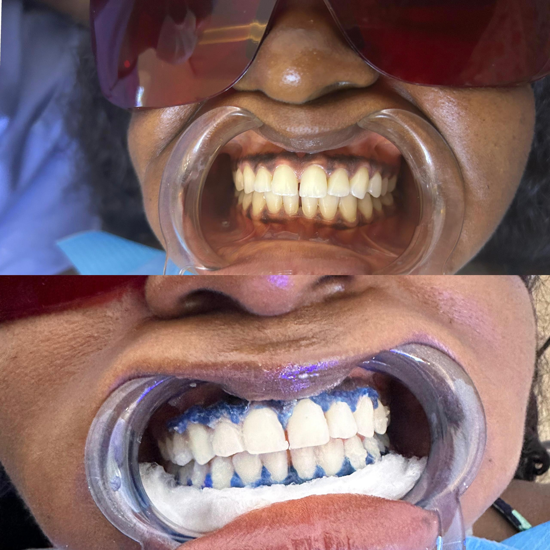 Teeth before whitening and with whitening gel applied during treatment
