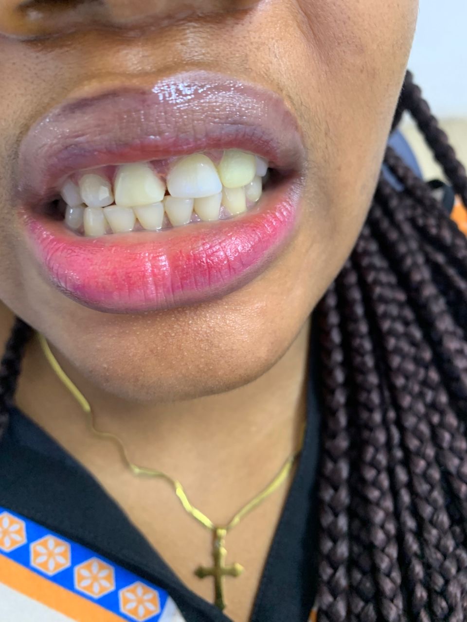 Replacing missing front teeth — after treatment