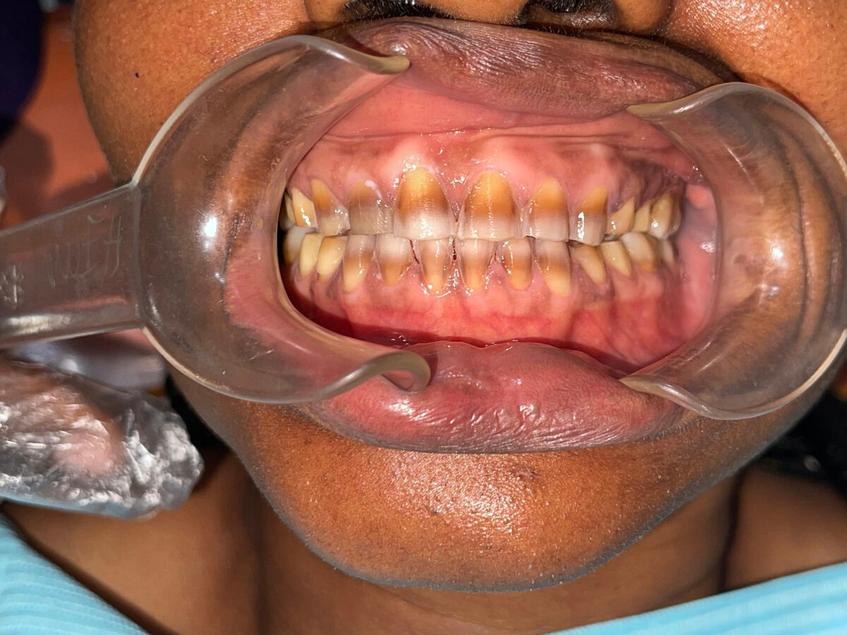 Uneven, worn front teeth rebuilt with veneers — before treatment