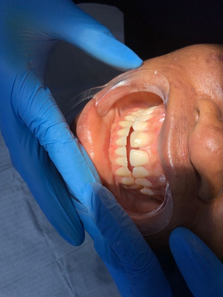 Repaired chipped front tooth — after treatment