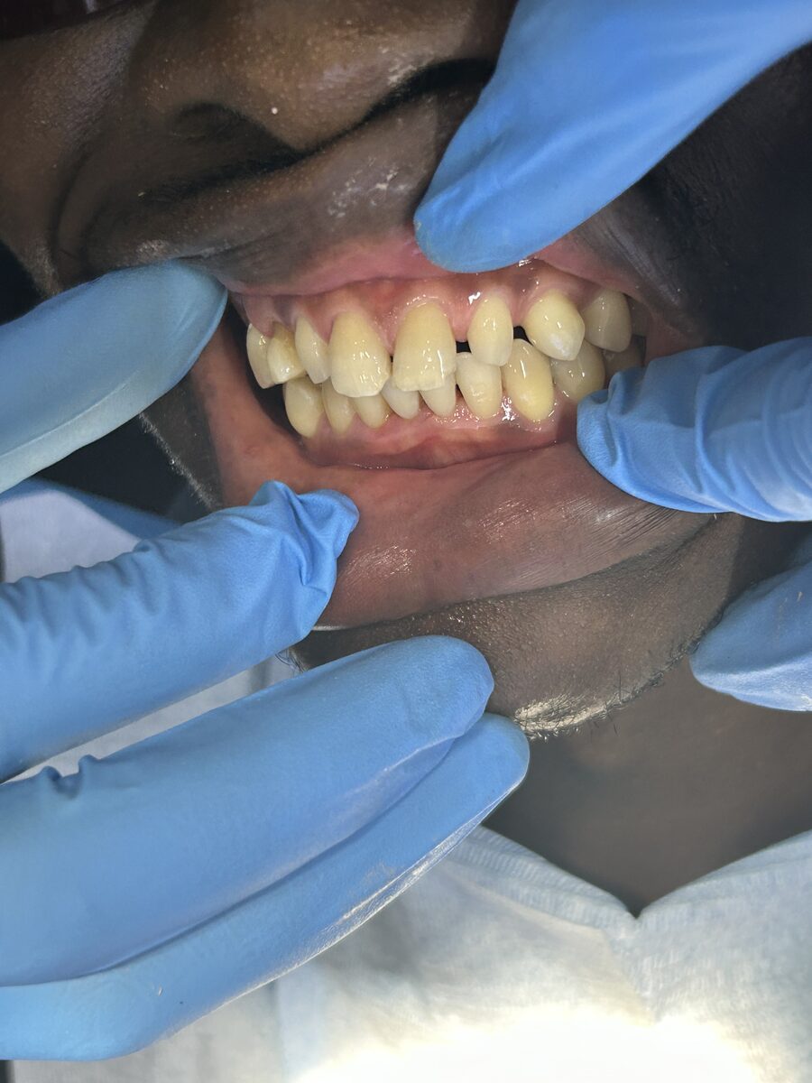 Cleaner gumline, smoother teeth — after treatment