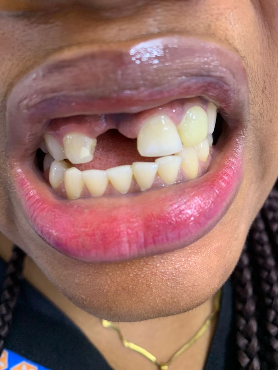 Replacing missing front teeth — before treatment