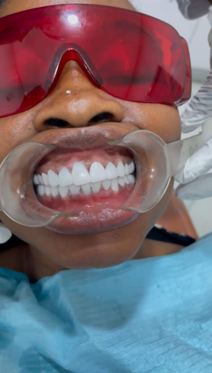 Uneven, worn front teeth rebuilt with veneers — after treatment