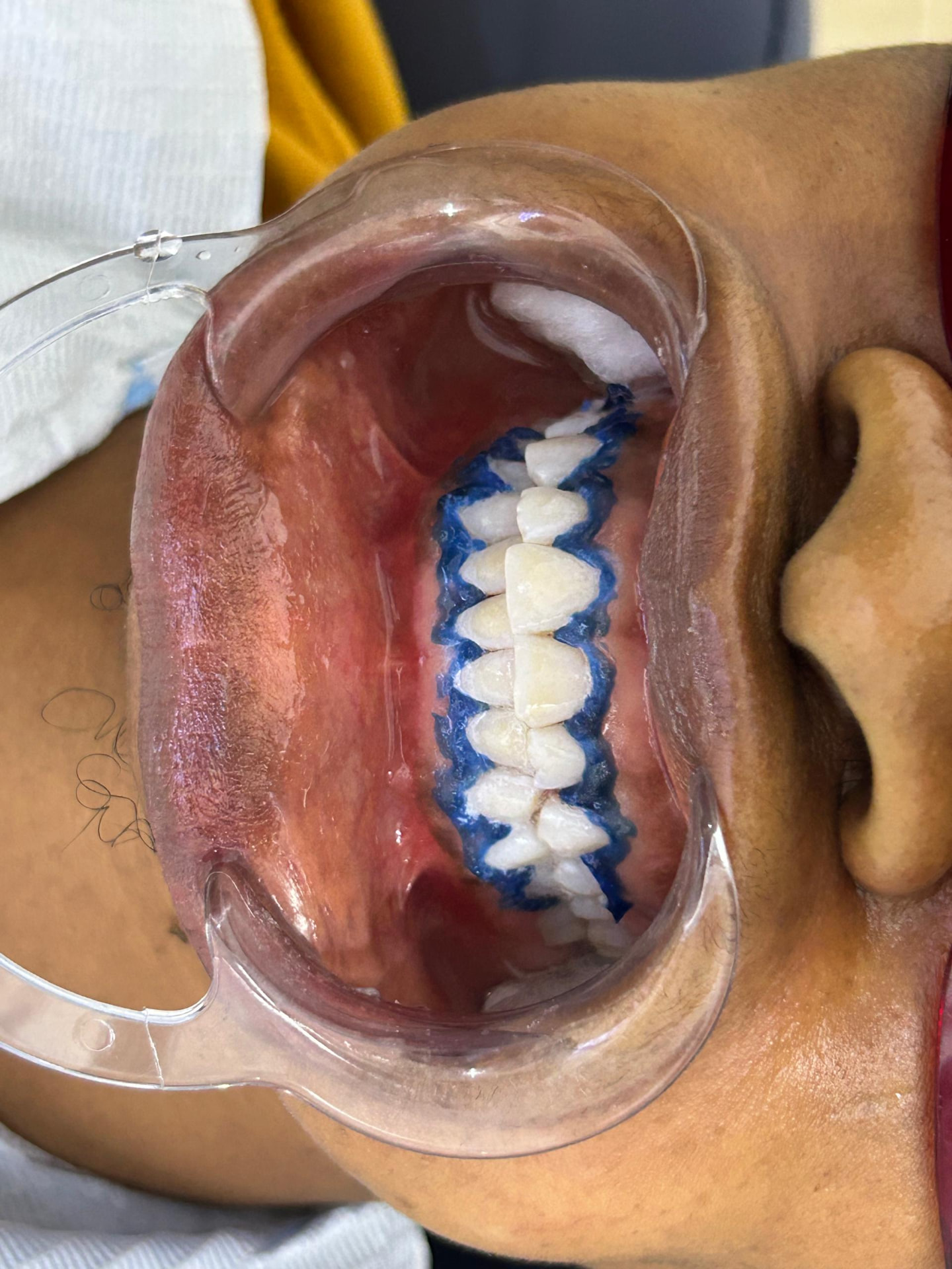 Close-up of whitening gel and gum barrier applied to the upper teeth