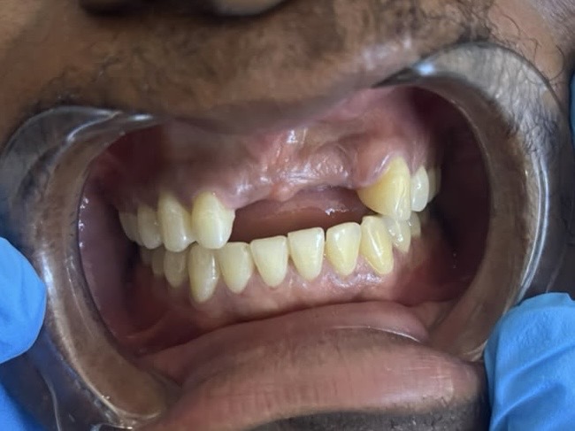 Closing gaps and rebuilding the bite — before treatment