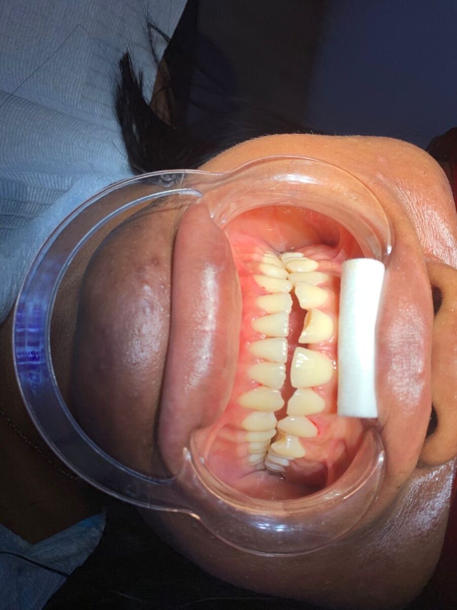 Repaired chipped front tooth — before treatment